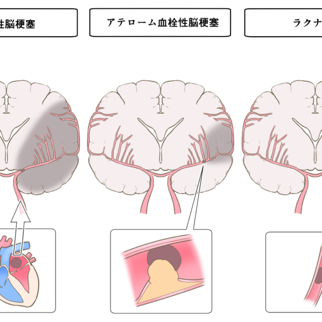 脳梗塞の基礎知識とリハビリ